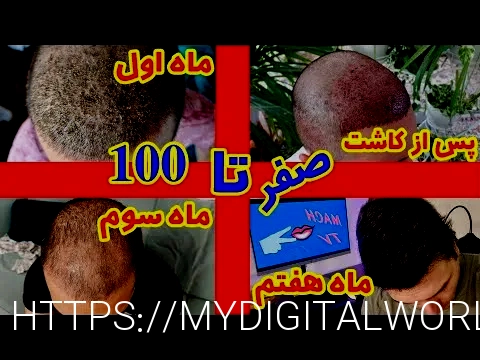 کاشت مو تهران